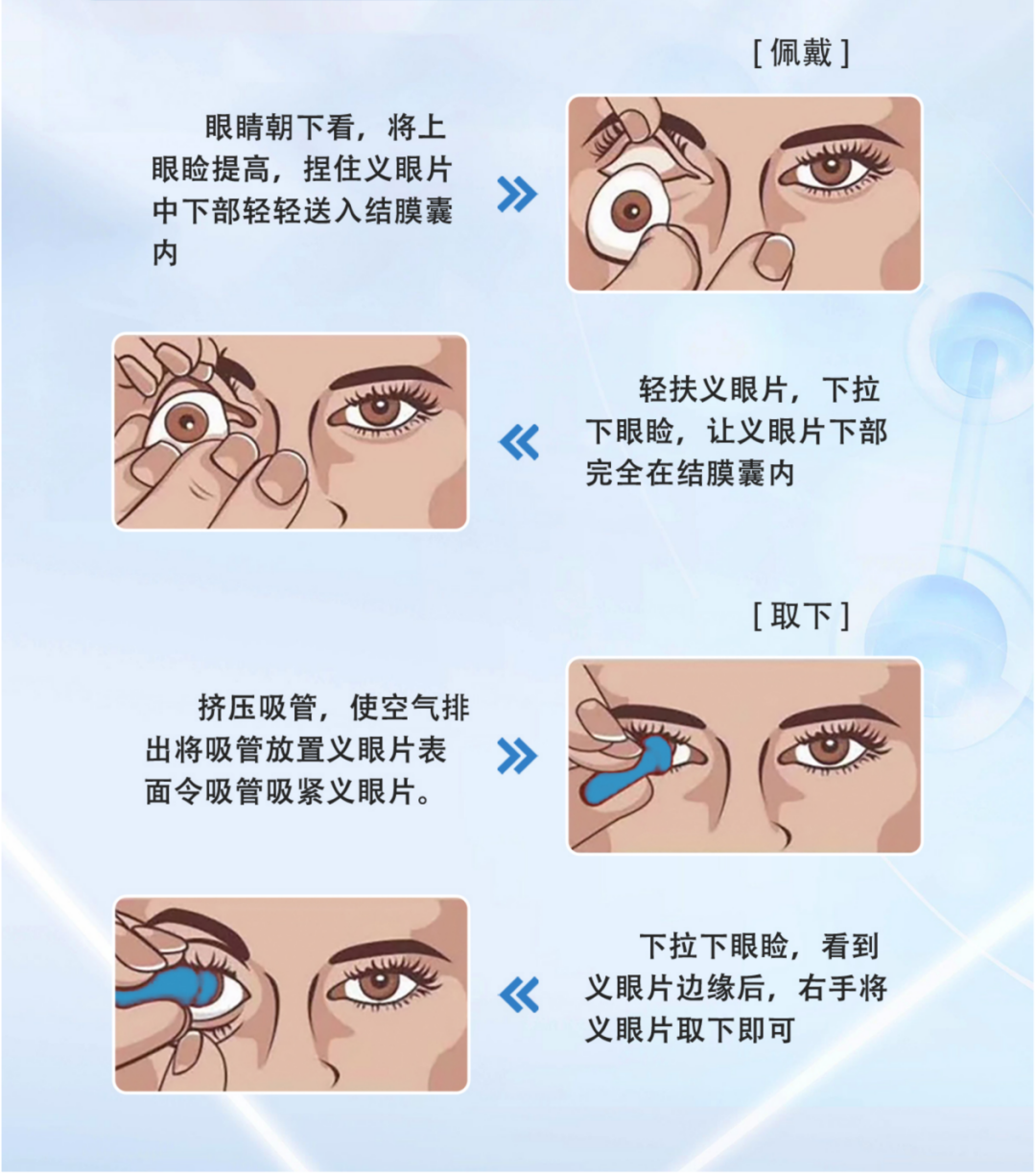 义眼科普:不治病、不恢复视力,为什么仍有很多人选择佩戴?