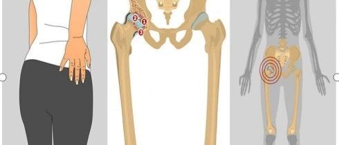 宝爸宝妈看过来！宝宝大腿纹路不一样？髋关节筛查你得早知道！