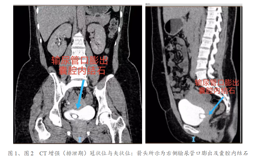 泌尿外科内镜微创“开窗”,一次解决输尿管膨出合并囊内结石