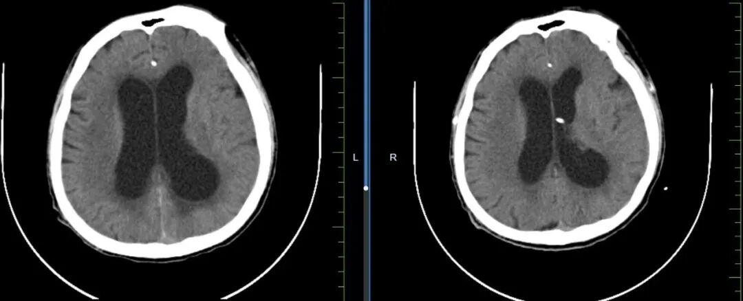 别把脑病当成 「老糊涂」