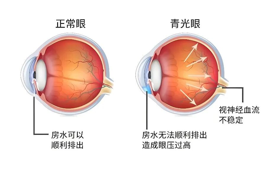 青光眼手术,一定要“开大刀”吗?
