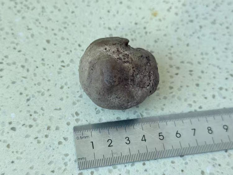 【健康科普】结石不痛就没事?一枚铸型结石差点毁掉她的肾脏