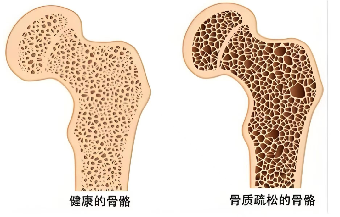 病房里她满心疑惑:“怎么会是我?”确诊骨质疏松先别慌!高风险人群这样做