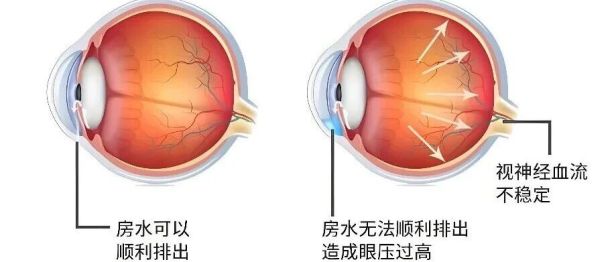 青光眼手术，一定要“开大刀”吗？