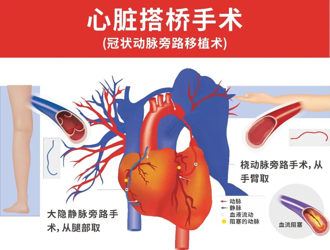 康复丨心脏搭桥后，腿肿了，是手术出问题了吗？