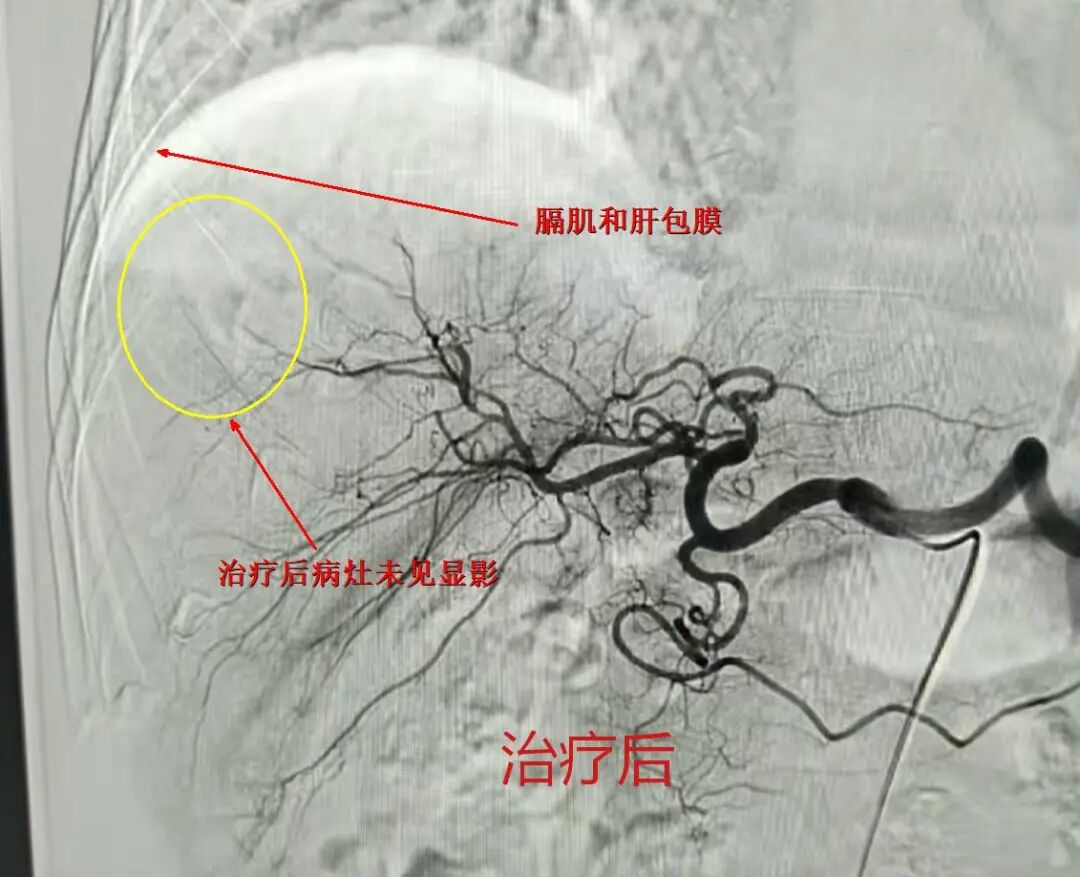 多学科协同攻坚:玉医首例肝包膜旁高危肝癌微波消融,为多发性骨髓瘤患者造血干细胞移植扫清障碍