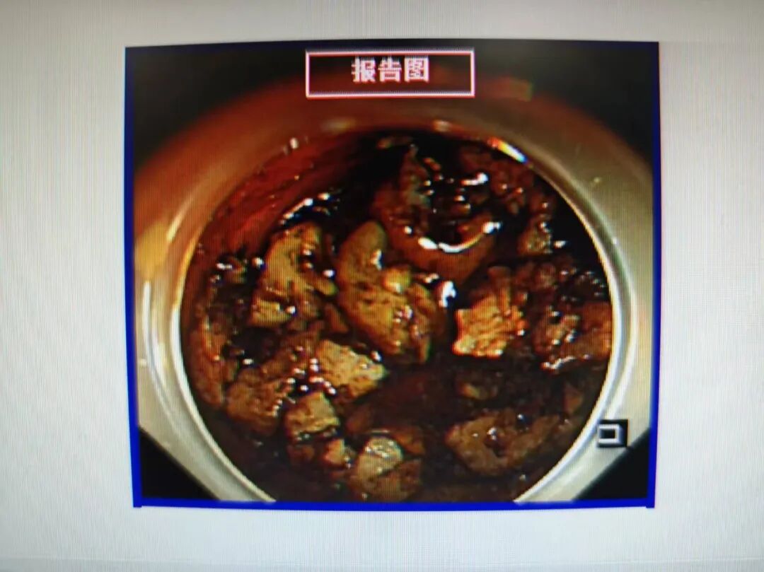 山楂、柿子别猛炫！一不小心吃出胃结石