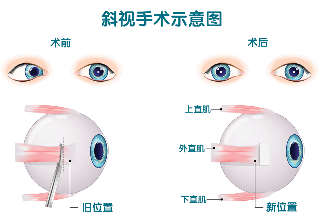 孩子斜视，手术会影响视力吗？要不要做、多久能恢复？一次说清