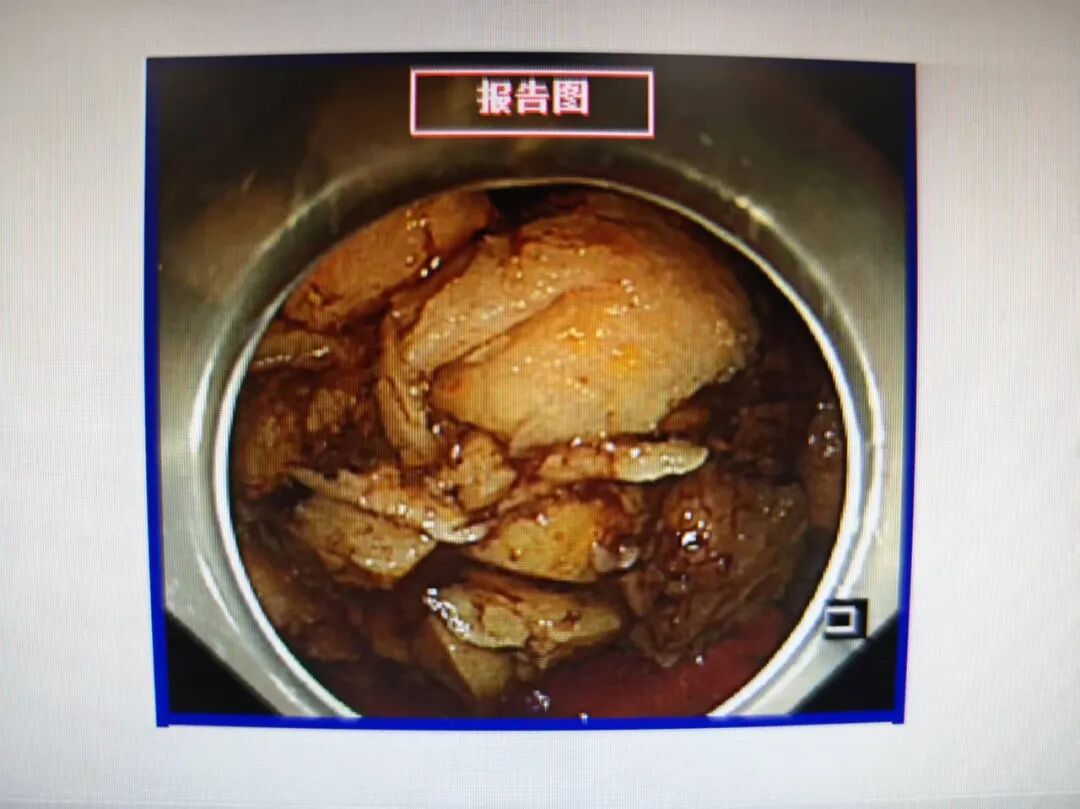 山楂、柿子别猛炫！一不小心吃出胃结石