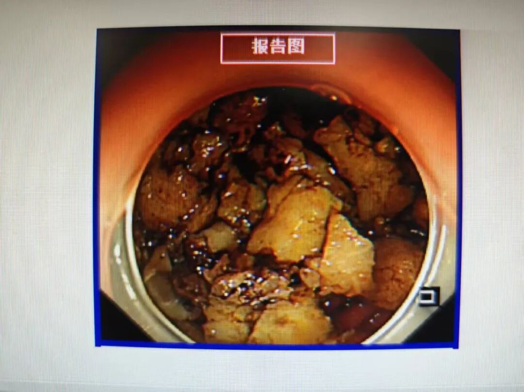 山楂、柿子别猛炫！一不小心吃出胃结石