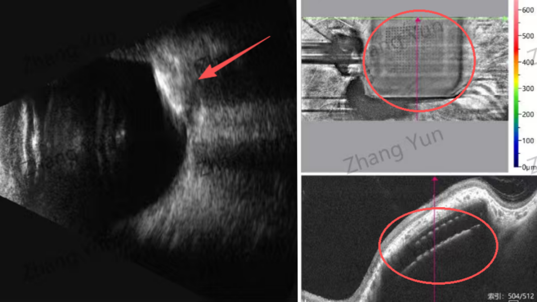 视觉重建!温医大眼视光医院成功开展全国首例黄斑区脉络膜下视网膜脑机接口手术