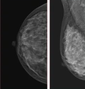 爱乳日｜女性健康的粉色杀手——乳腺癌