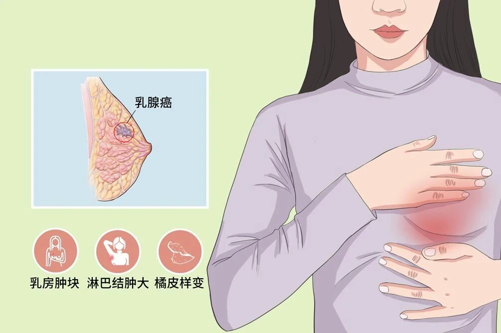 爱乳日｜女性健康的粉色杀手——乳腺癌