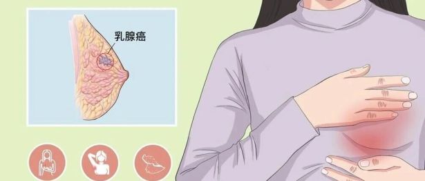 爱乳日｜女性健康的粉色杀手——乳腺癌