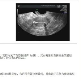 绝经两年，节育环 “长” 进子宫里！突发腹痛千万别硬扛