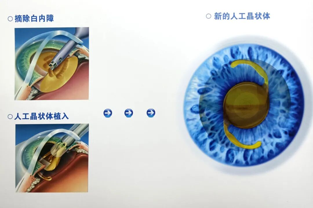 白内障不是老年人的专属，做好 5 点可预防