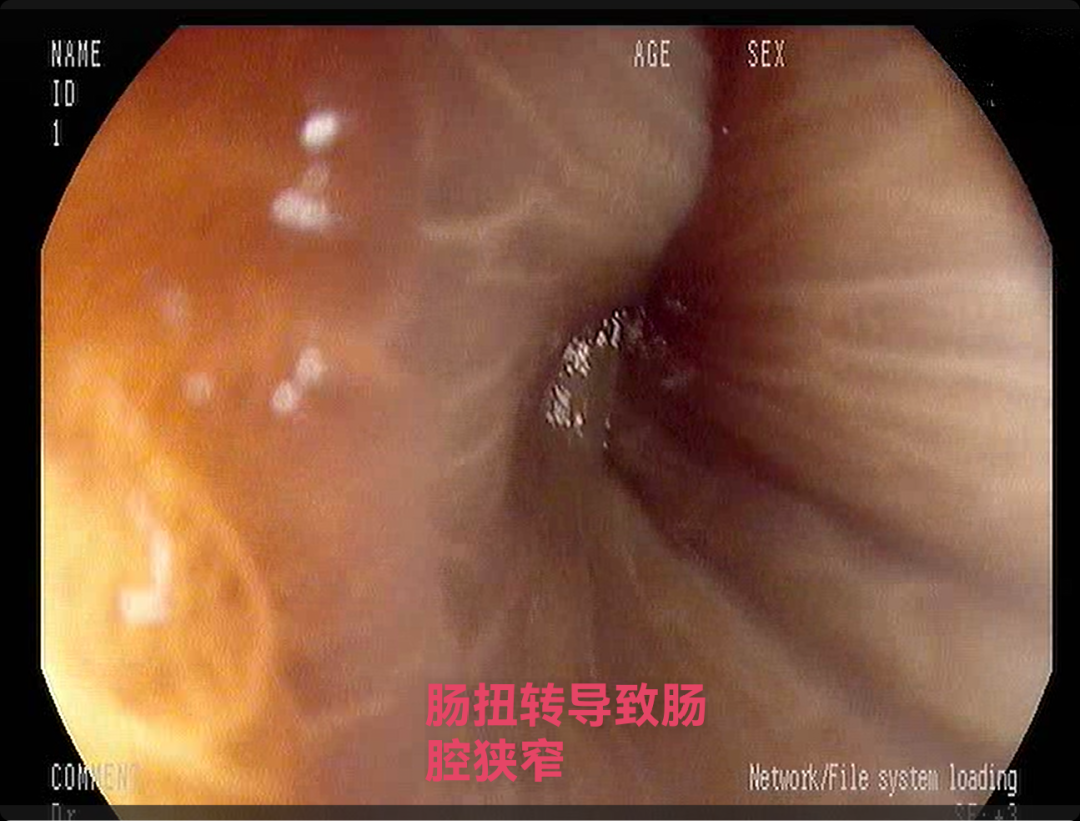 【一医好技术】81 岁老人腹胀如鼓！内镜微创化解乙状结肠扭转肠梗阻