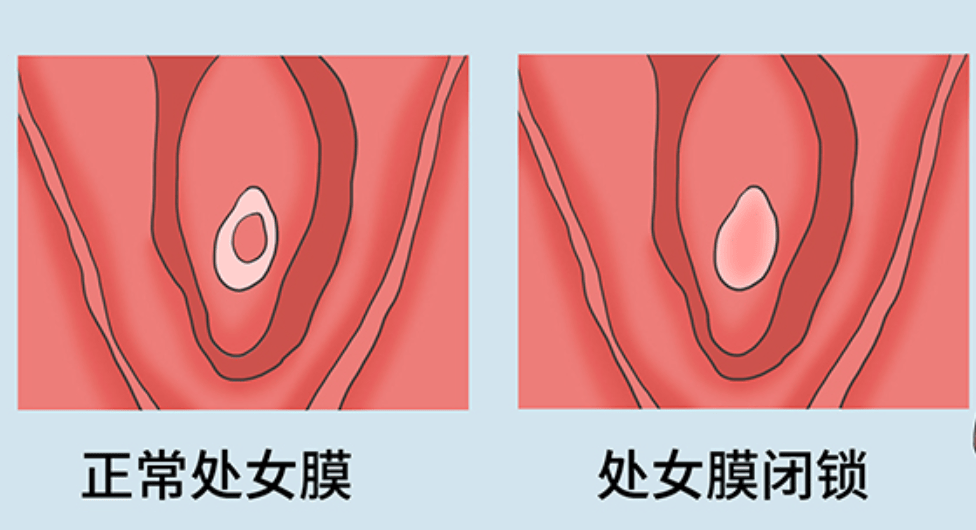 失踪的月经：少女肚子变大，流言四起，真相出乎意料