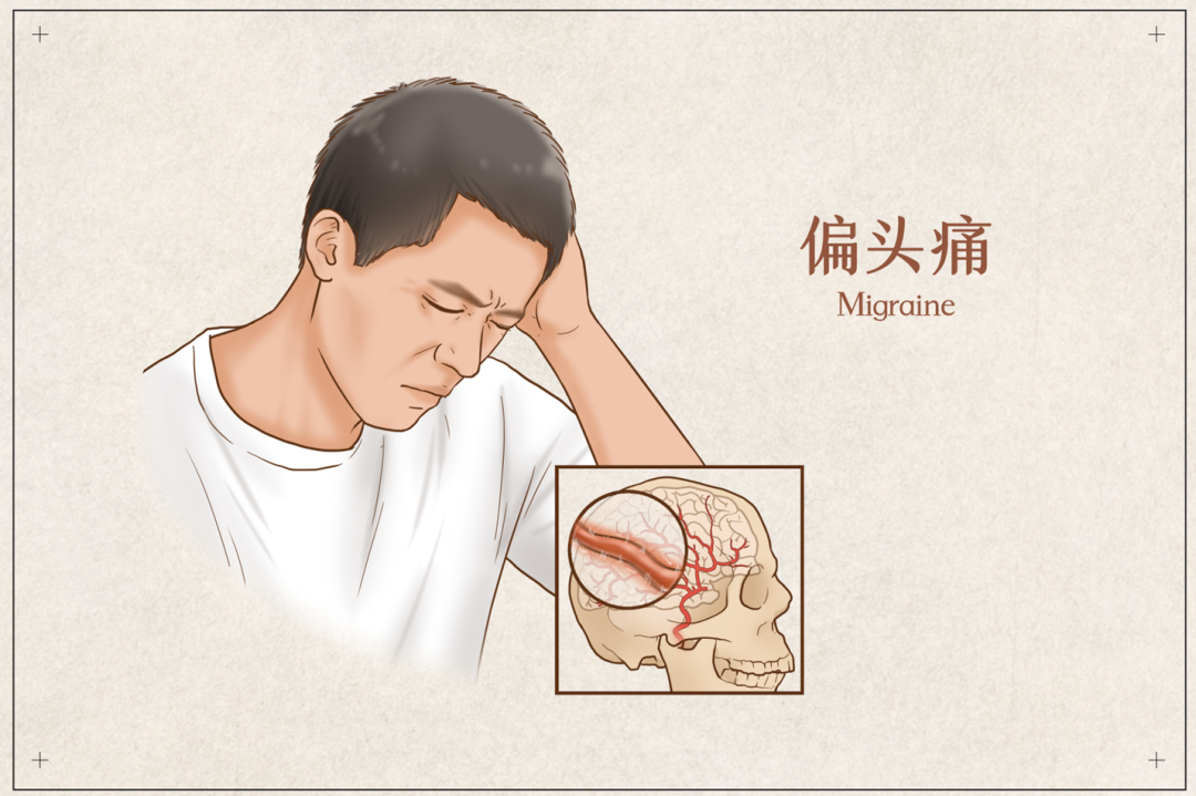 【医点就通】打工人的“隐形工伤”——偏头痛！从“头痛医头”到“调肝脾肾”，中西医联手掐断痛点