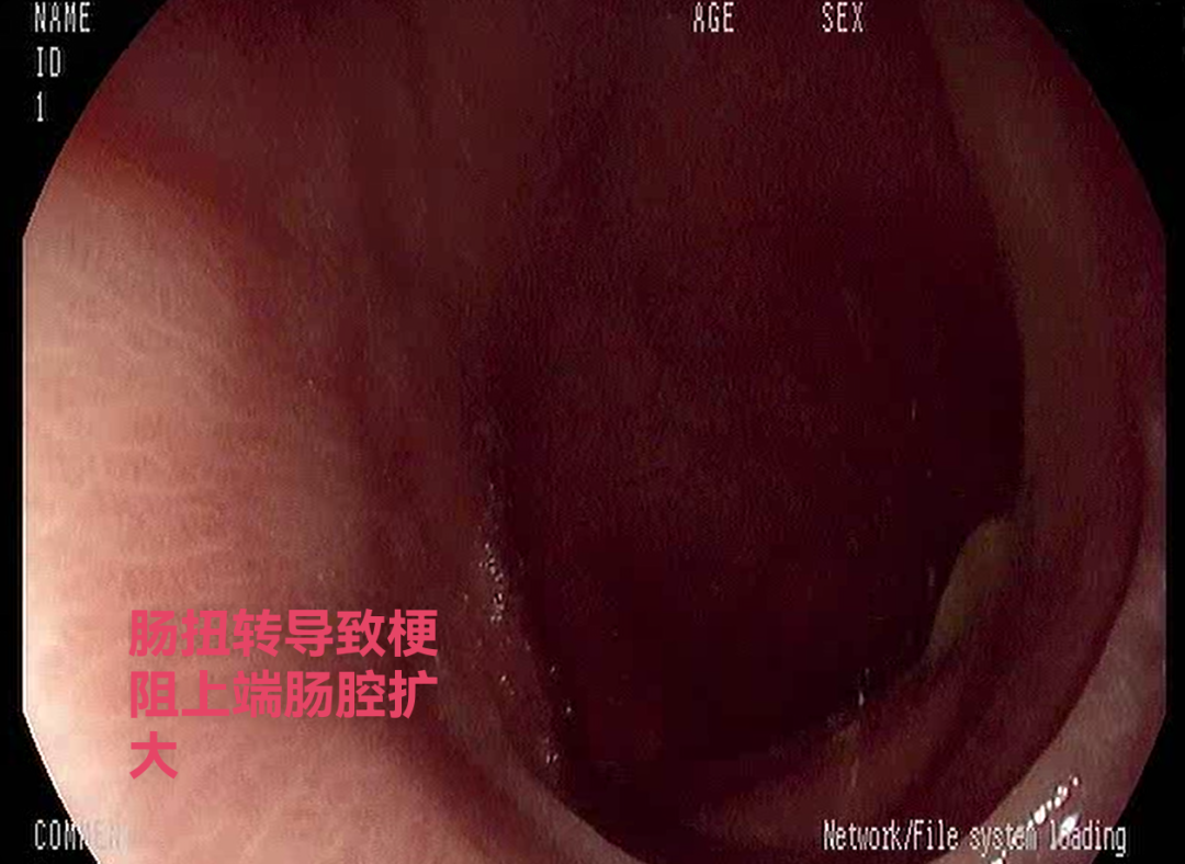 【一医好技术】81 岁老人腹胀如鼓！内镜微创化解乙状结肠扭转肠梗阻