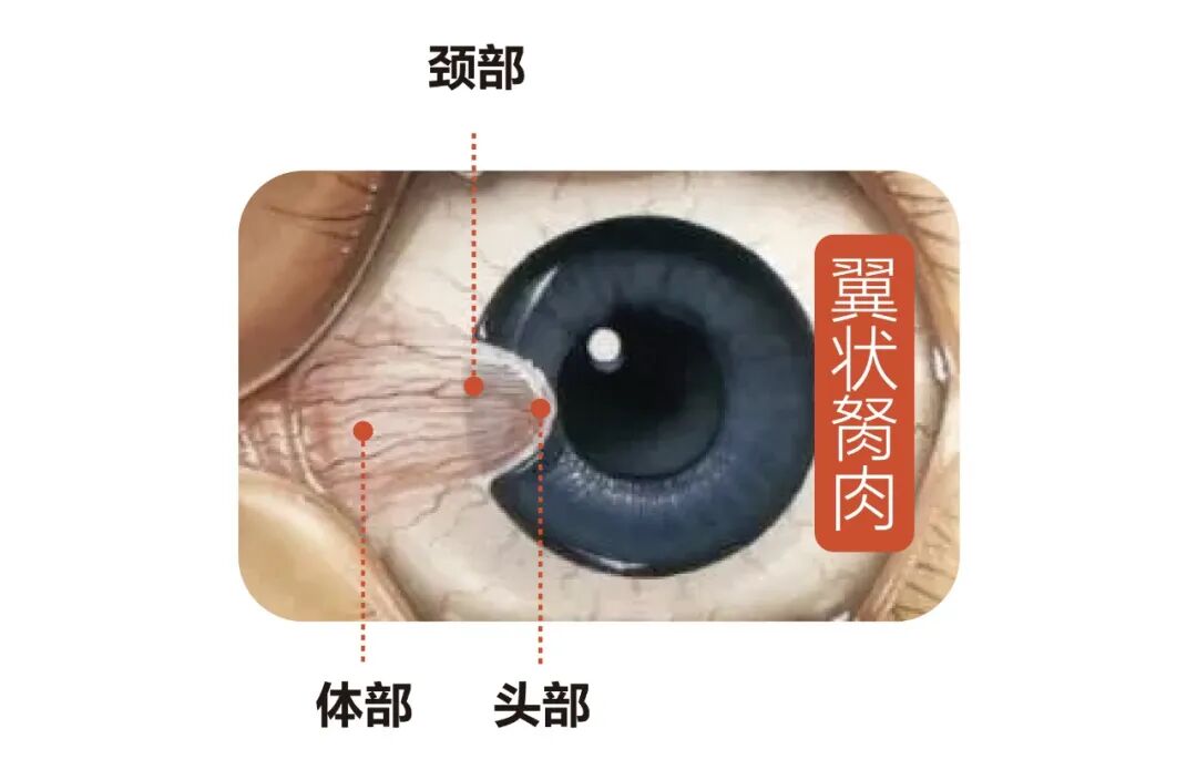 得了翼状胬肉,要切掉吗?