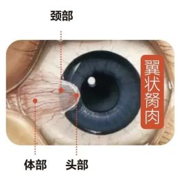 得了翼状胬肉，要切掉吗？