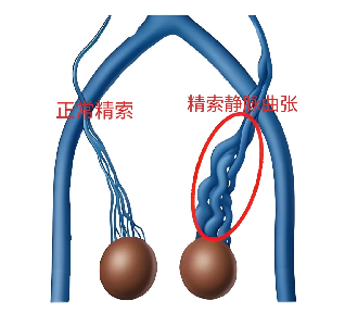 “小蚯蚓” 找上门?一文读懂精索静脉曲张