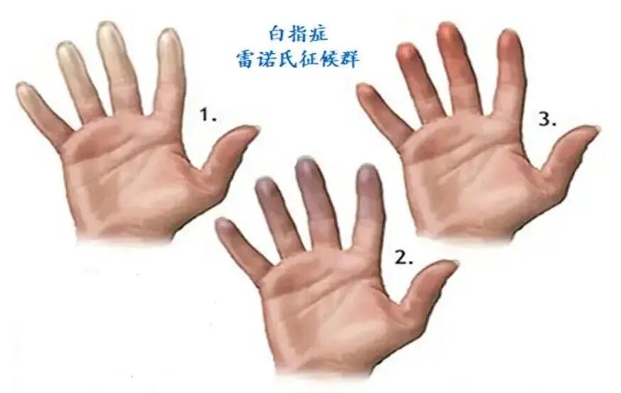 手麻、发白、遇冷刺痛？警惕物理因素职业病——手臂振动病