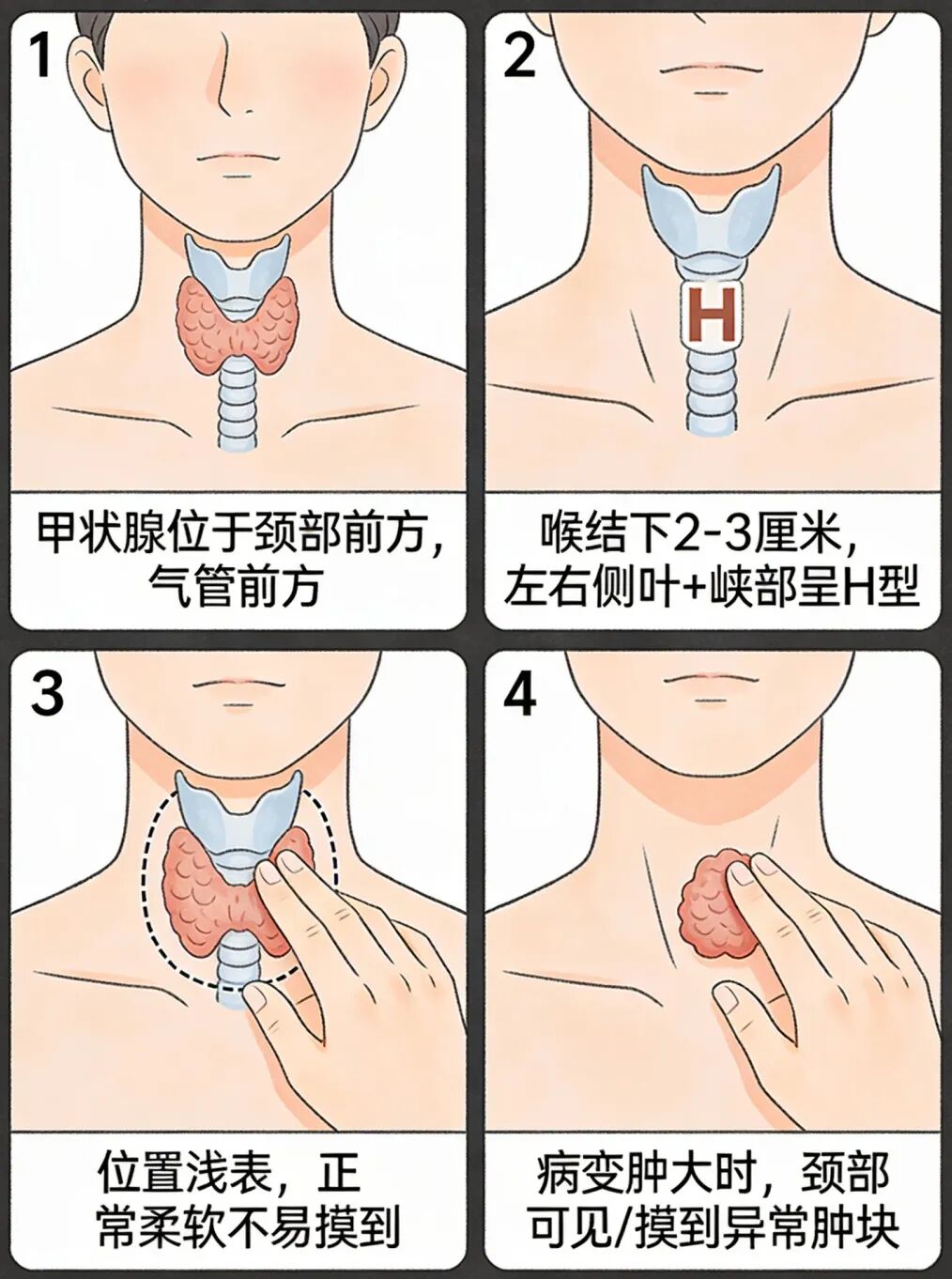 15岁高中生确诊甲状腺癌，脖子查出结节别慌，绝大多数是……