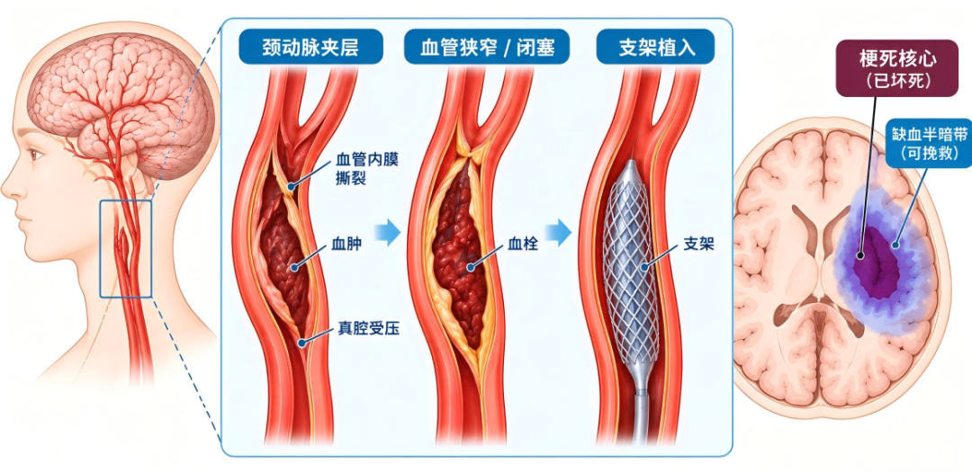 偏瘫失语一两天,还有救治机会吗?脑梗发病48小时,不等于只能认命!