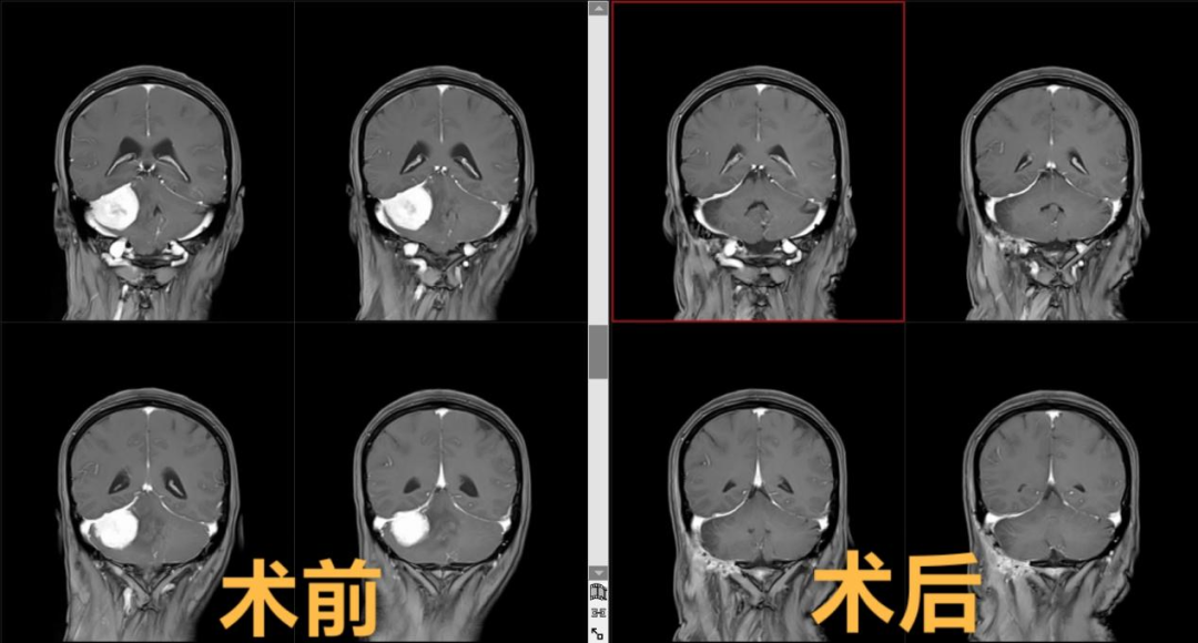 颅内 “拆弹”！二附院神经外科完成巨大小脑脑膜瘤切除术
