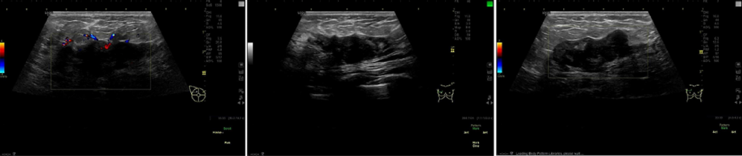 粉红丝带月丨关注女性健康,62岁查出乳腺4b类