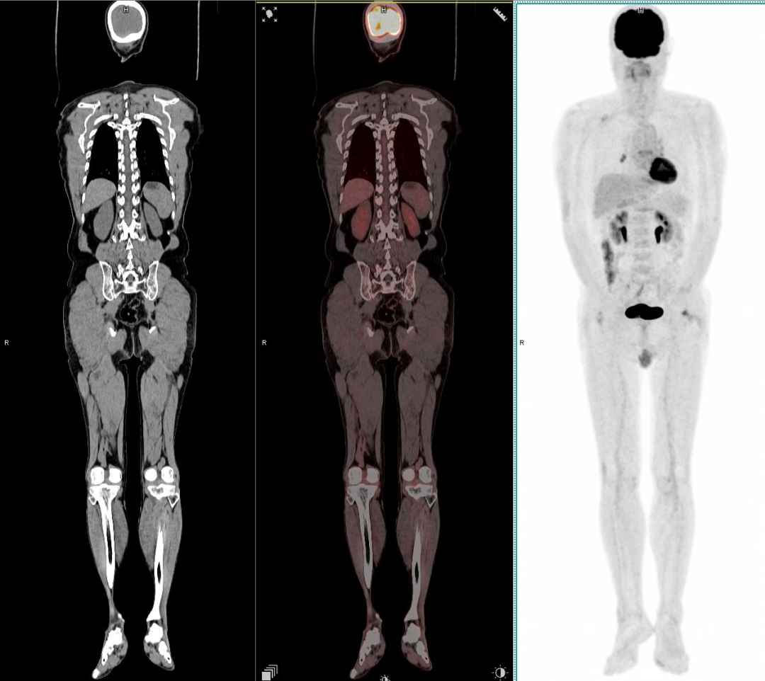 “谈核色变”的PET-CT,哪些人真该做,哪些人别乱做