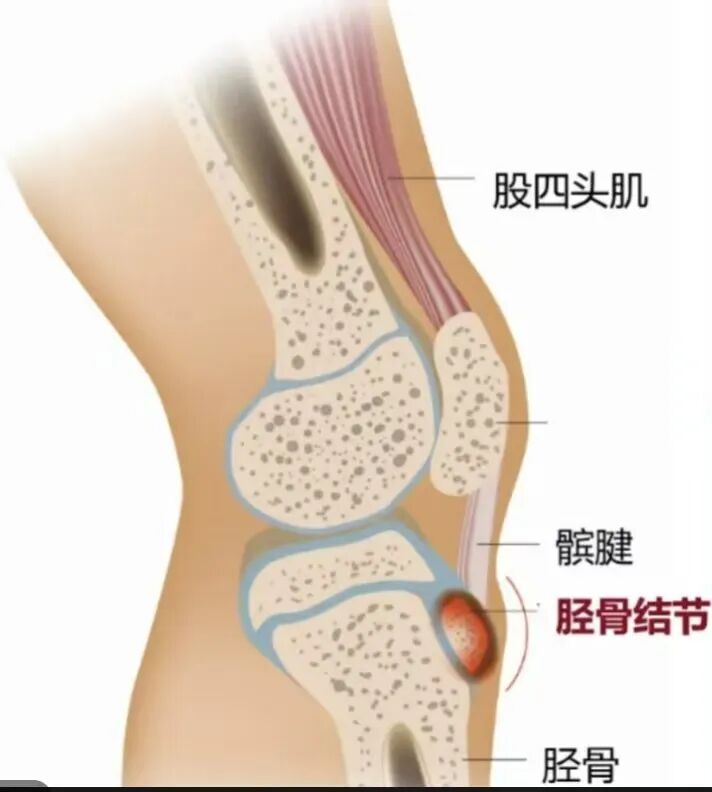 膝盖下面鼓个包还一跑就疼?可能是“生长痛”在作怪!
