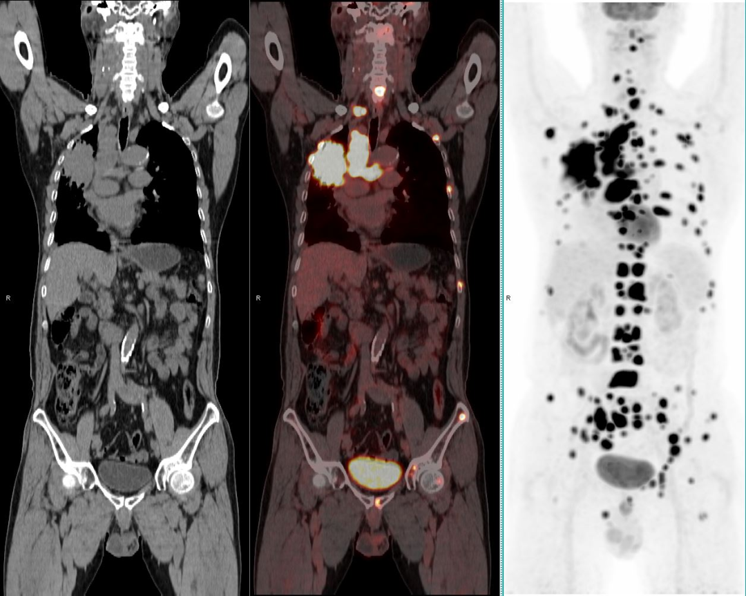 “谈核色变”的PET-CT,哪些人真该做,哪些人别乱做
