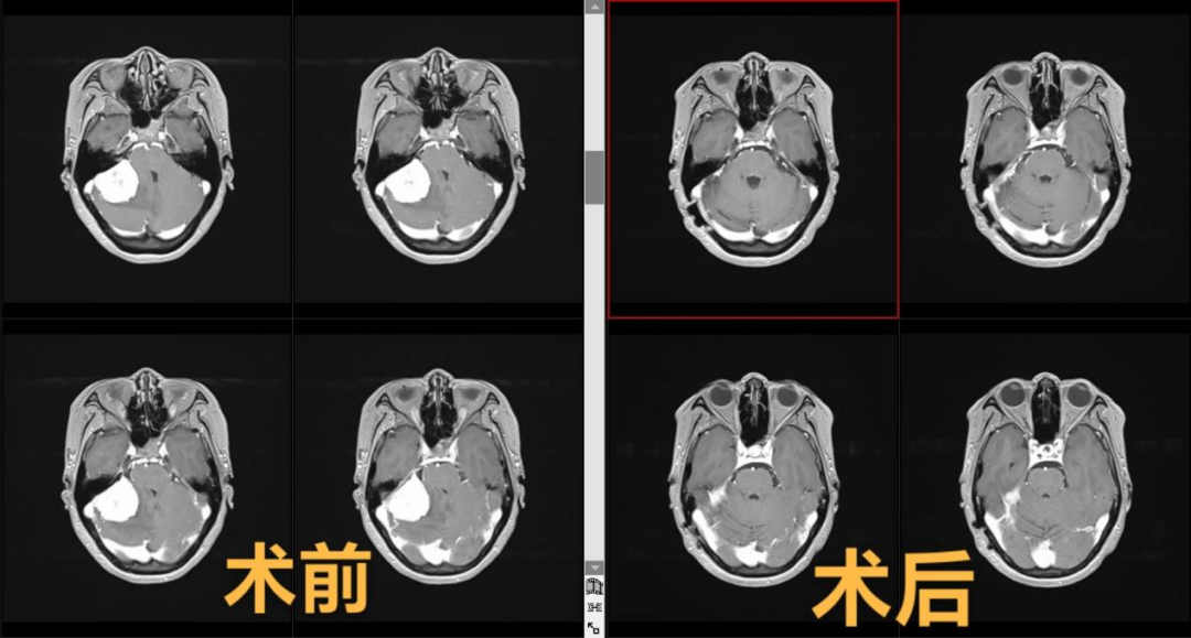 颅内 “拆弹”！二附院神经外科完成巨大小脑脑膜瘤切除术