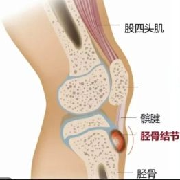 膝盖下面鼓个包还一跑就疼？可能是“生长痛”在作怪！