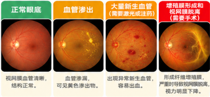 瑞科普丨眼睛看得清，眼底就没问题？糖尿病患者，这份护眼提醒请收好