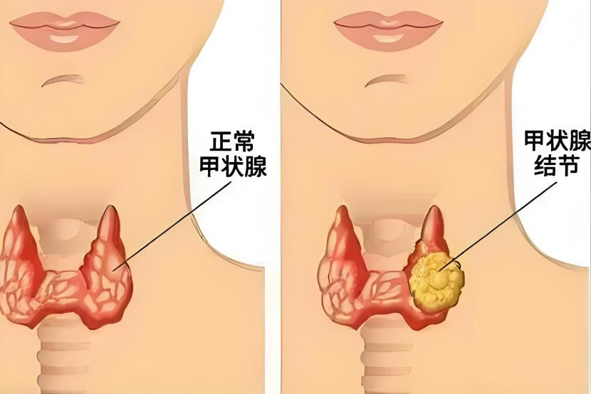 查出甲状腺肿块,先别慌!90%都是良性的