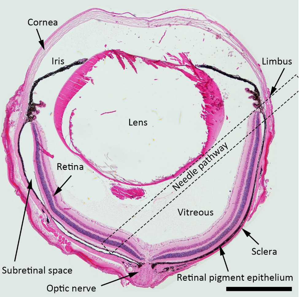 视网膜下注射 (SRI)