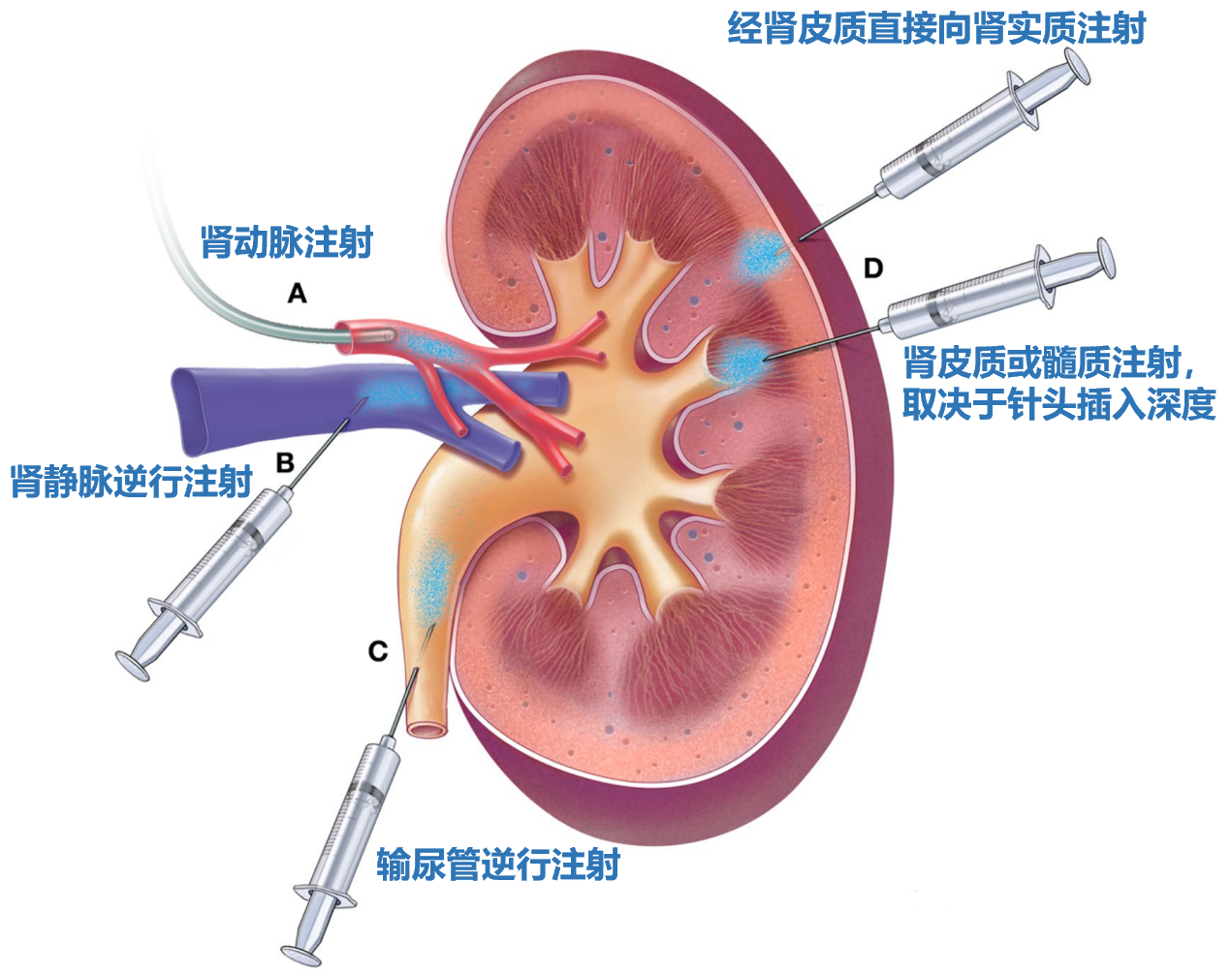 肾实质注射