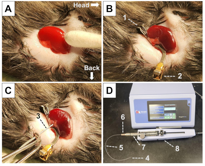肾盂注射 (逆行灌注)