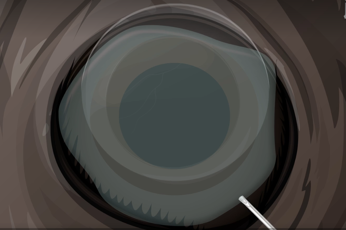 视网膜下注射 (SRI)