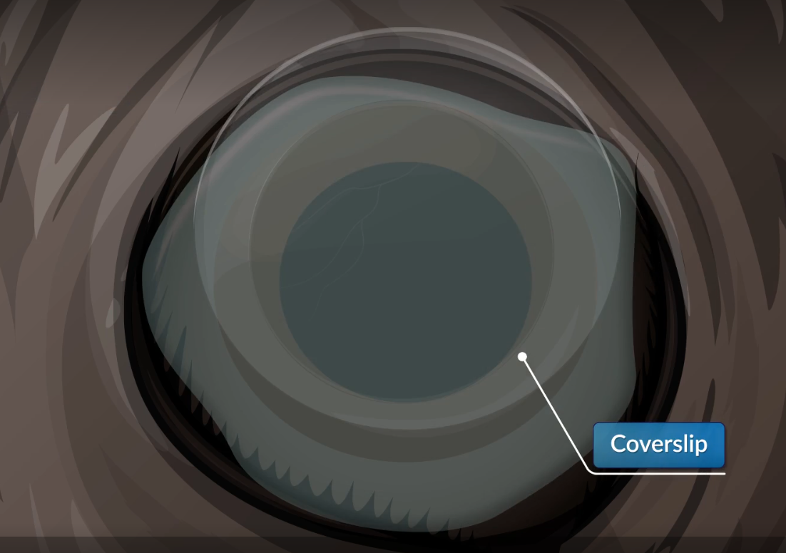 视网膜下注射 (SRI)