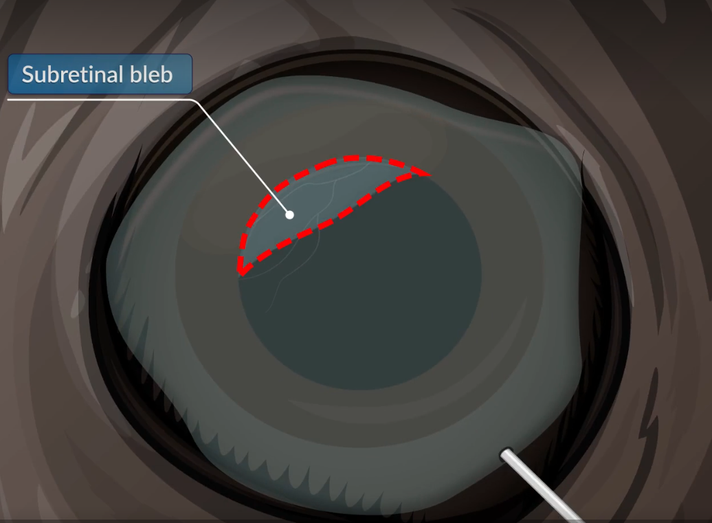 视网膜下注射 (SRI)