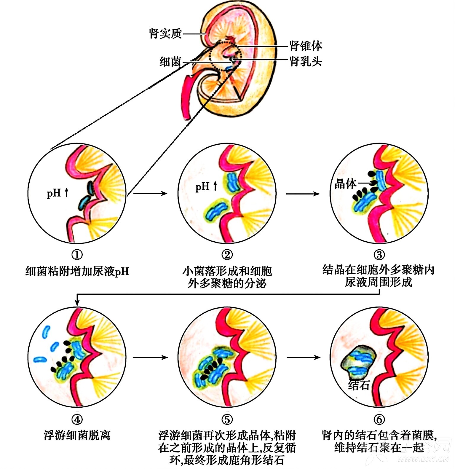 肾结石